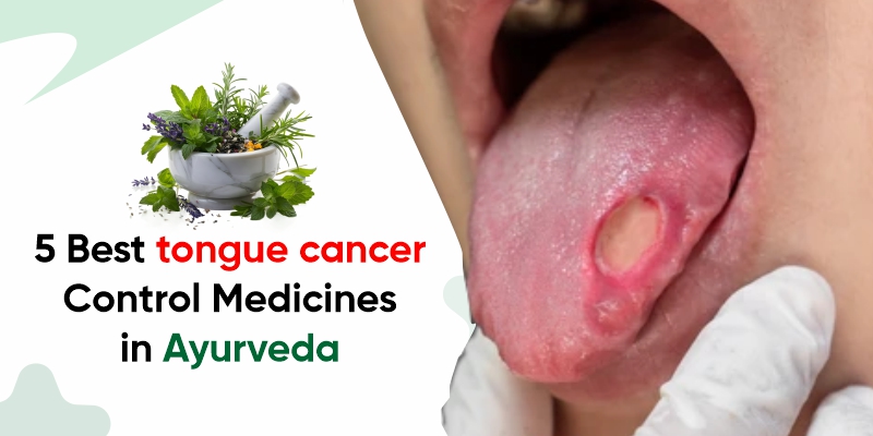 tongue-cancer-control-medicines-in-ayurveda